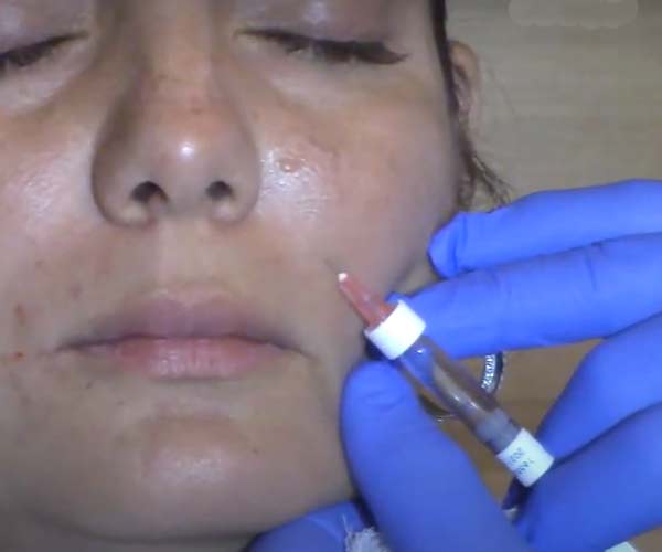 Banner del precio de Juvederm