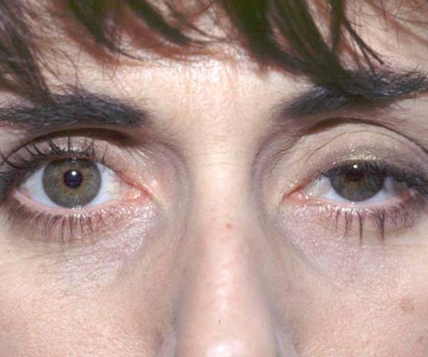 Banner del tratamiento de Ptosis para aplicacion