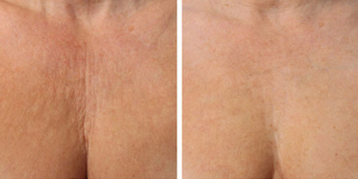 antes y despues de recibir el tratamiento en el pecho