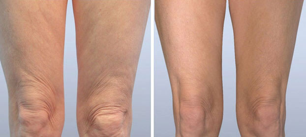 antes y despues de recibir el tratamiento en las piernas