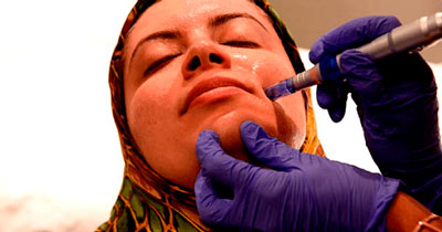 Fotografía de una sesión de estética facial con bioestimuladores