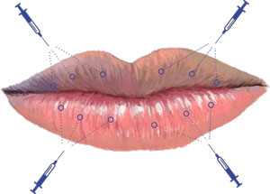 Antes del tratamiento de relleno de labios