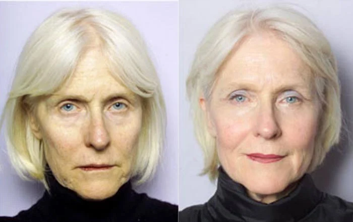 Imágen de antes y después de inyección de sculptra