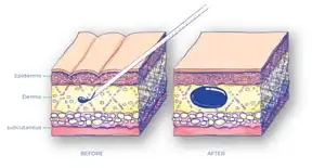 Curso de Rellenos Dermicos
